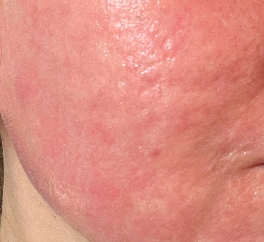 Recovery photo from my CO2 laser treatment