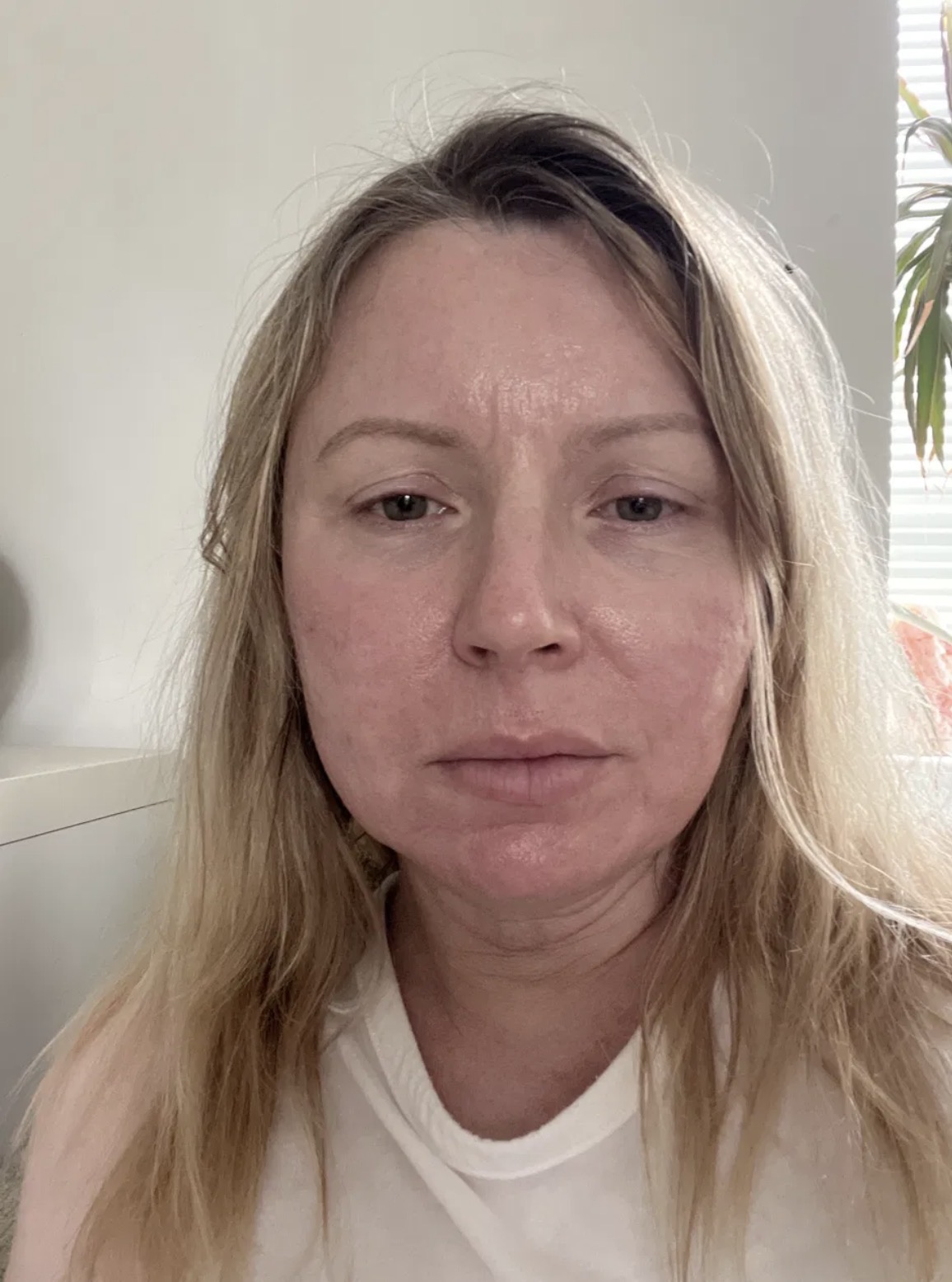 Kerry, no make up, 12 days post CO2 laser